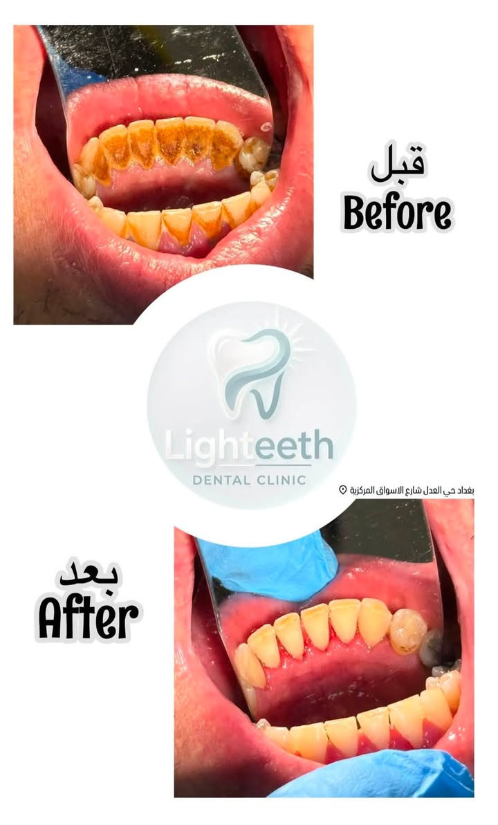 عيادةlighteeth
لدكتور
اسامة احمد الحسني
لزراعة وتقويم وتجميل الاسنان توجد خدمة طوارئ الاسنان
وتتواجد طبيبة 
تجميل أخصائية
فلروبوتوكس ونضارة للوجهه
أوقات الدوام
من الساعة ال ١٠ صباحاٍ حتى الساعة ال ١٠ مساءا
موقع العيادة:
حي العدل
-شارع الأسواق المركزية -
مجاور حاجة الف
لحجز واتساب او التواصل عبر الخاص.
***********
