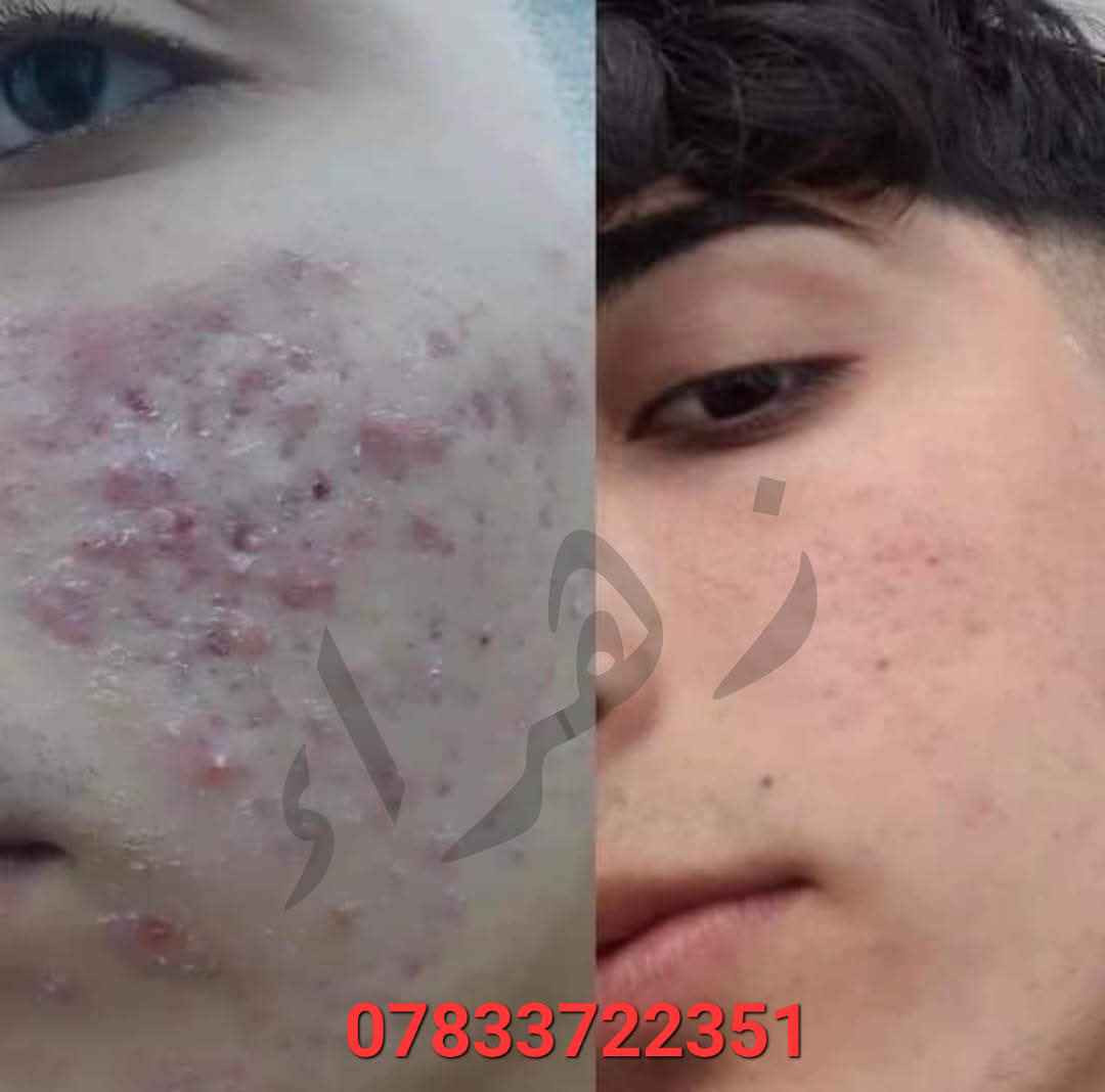 الف رحمه على روح امه وابوه اليعلقلي هذا مصدر رزقي الوحيد #يارزاق 🤲❤️
خلطة بشرة تجنن تسوي الوجه گيمر 
طبعا تستخدم للرجال ونساء 

#خلطه عباره عن سيرومات مابيه اي مضره  شغلها يخبل  وفوائده تجنن على بشره 
تعالج مشاكل البشره تصبغات اسمرار كلف حبوب نمش يعني هي تساعد البشره تعيد حيويته تنطيه نضاره حلوه

للحجز مراسله الخاص
او واتساب *********** دهل اوران, واسط
