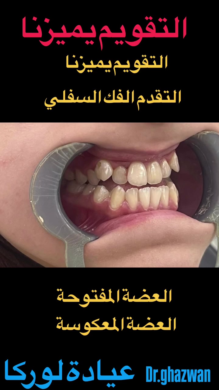 التقويم يميزنا احد اعقد و اصعب الحالات تقدم الفك السفلي و عدم اكتمال العلوي و عدم تطابق الاسنان يعاني من مظهر خارجي غير متناسق عدم اطباق الاسنان اثناء اغلاق الفم عدم القدرة على تقطيع الطعام عدم القدرة على تنظيف الأسنان بالصورة الصحيحة عدم التلفظ او مشاكل اثناء الكلام انزعاجات اثناء النوم…. علاج جميع الحالات الصعبة و المستعصية خبرة علمية متمكنة بالصورة الطبية تجميل الاسنان بصورة مثالية اسعار مناسبة بالتقسيط المريح الفحص و جلسات علاج التقويم مجانا .. دكتور غزوان مزهر بغداد الكرخ نفق الشرطة بداية شارع الاطباء عيادة لوركا فوق صيدلية كنز النفق متوفر واتس *********** #تقويم_الأسنان_والفكين #تقويمالأسنان #تقويم_الأسنان_بأنواعه #تقويم_الشفاف_للأسنان #تقويم_الأسنان_قبل_وبعد @تقويم_الاسنان @تقدم_الفك_السفلي @العضة_المعكوسة @العضة_المفتوحة
