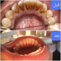 تنظيف أسنان • تلميع أسنان • بعقوبة المفرق