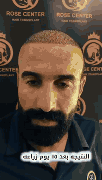 بعد مرور ١٠ إلى ١٢ يوم من زراعة الشعر…
انتهت مرحلة النقاهة، التأمَت المنطقة المانحة، وبدأت ملامح النتيجة تَظهر بثقة.
هذه فقط البداية!🥰
🌹  مركز روز  🌹

📲 احجز الآن – الفرصة محدودة
تواصل على الصفحه او الاتصال على
ارقام المركز 👈🏻 ***********

📍العنوان 💫 المنصور شارع 14 رمضان داخل فرع مطبخ هكر الألماني 
ننتظركم بكل حب🫶🏻
