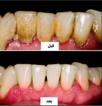 قلع أسنان • تنظيف أسنان • خدمة علاجية مجانية