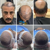 عملية إعادة زراعة شعر فاشله❌  نقوم بإصلاح ما أفسده الآخرون🚫  مو كل فشل...