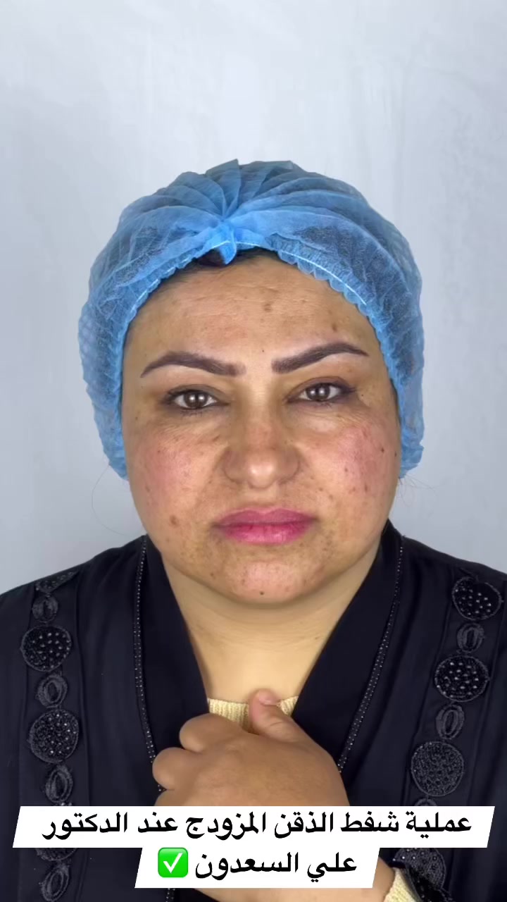 النتيجة مباشرتاً قبل وبعد عملية شفط الذقن المزدوج ✅

موقعنا / المحمودية_حي الربيعي_بالقرب من البريد_فرع مرطبات البركه 
للحجز والاستفسار 
***********
