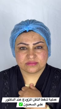 شفط ذقن مزدوج • نتيجة مباشرة • المحمودية الربيعي