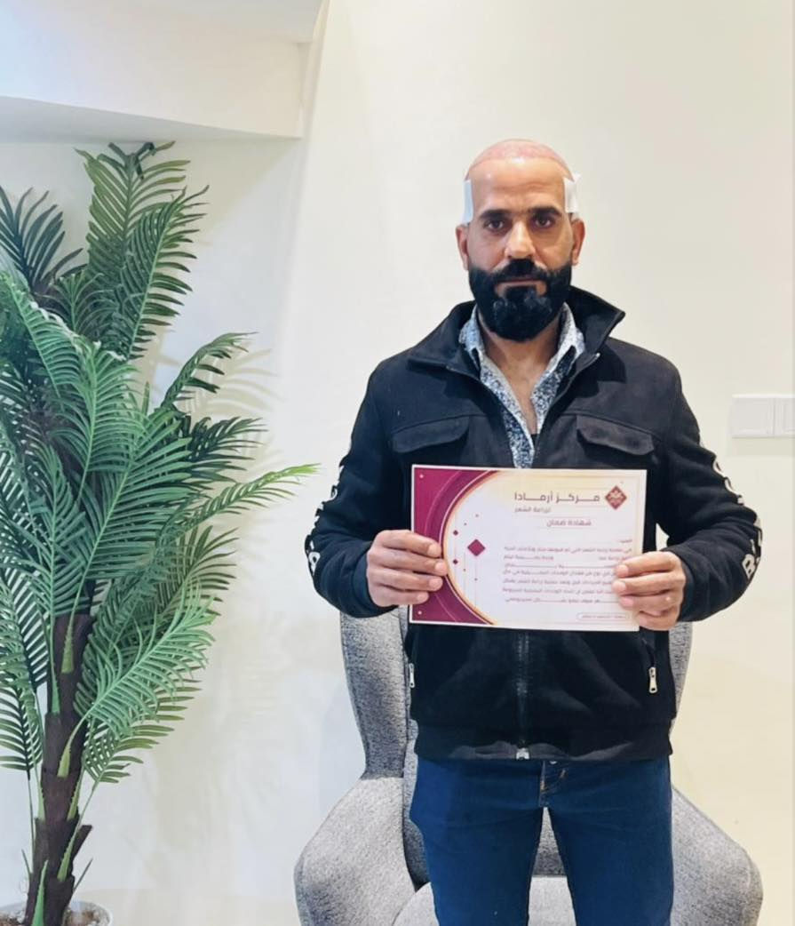 🔥🔥عرض العيد🔥🔥
     
🦋اكيد الكثافه يمنا وبس 🦋

🔥اخلص من مشاكل الشعر وانسى الصلع ويانا 🔥
✨زراعة الشعر بتقنية الـ 3D و6Dوبنفس اتجاه الشعر الطبيعي 
       🔥بتغطية كامله للصلع بجلسة واحده فقط 🙂💯
🔥ورسمه تكون حسب اختيارك وطلبك🧚‍♀️
‌‎ 🔥قطف بإعداد مفتوحه من البصيلات (دون تشوه و اثار بالمنطقه المانحه)
 🔥فتح قنوات بتقنية السفير استخذام فعلي وليس اعلان
 🔥تتم العمليه ع ايادي اطباء مختصين🦋

☄️فقط في مركز ارمادا التخصصي للزراعة الشعر ☄️

‏🌪{𝑉𝐼𝑃 𝑆𝑃𝐸𝐶𝐼𝐴𝐿}🌪العرض الذهبي 750 الف 🔥  

✨10جلسات بلازما ايطالي المنشأ مجاناً💥
✨10 ميزو ثيرابي اسباني المنشأ مجاناً 💥
✨جلستين نضاره للبشره مجاناً💥
✨حقيبه علاجيه متكامله💥
✨وجبة طعام للمريض 💥
✨يشمل العرض كل التحاليل والفحوصات💥
✨تخدير موضعي بجهاز الكومفورت دون الم 
✨العناية بشعر وغسلة لمدة 12 يوم💥
✨شهادة ضمان مدى الحياة💥
✨العناية بشعر المزروع لمدة سنه💥

️ ️️~يتوفر نظام الاقساط 🕊️
      ~القسط الشهري بدون مقدمه 🌪️
~لحاملي بطاقة الماستر كارد الرافدين حصرآ🪐

🦋العنوان :- المنصور ١٤ رمضان  
🦋للحجز و الاستفسار :-الاتصال ع الارقام التاليه

***********
