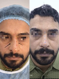 تجميل أنف • تعديل انحراف • الشطرة