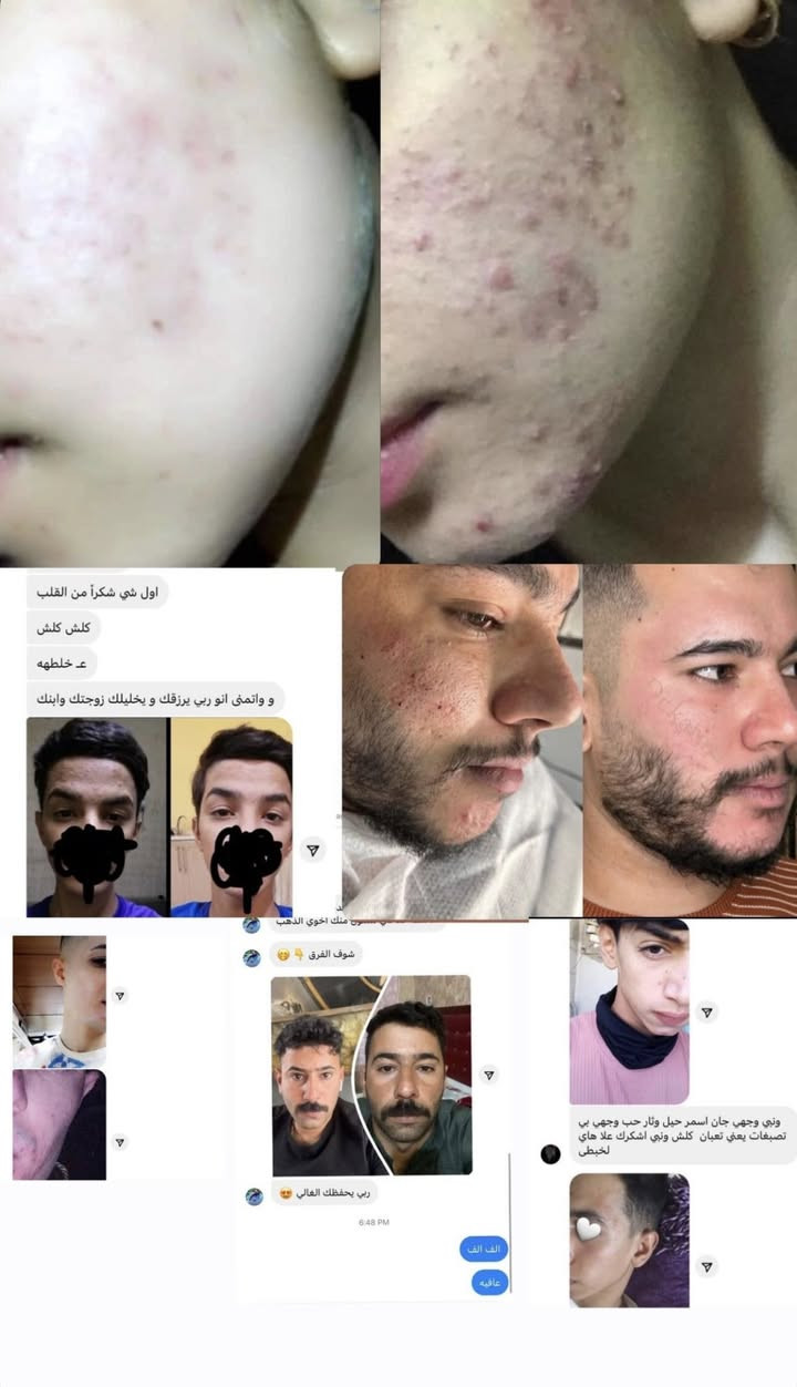 بسم الله 
توفرت كمية جديدة من خلطة الجمال الي راح تخلص كل الشباب والبنات من المشاكل الحب او الاسمرار او النمش هاي الخلطه هيه الي راح تحل مشاكلكم تصفي الوجه وتنطي تبييض ونضاره وضمان 10 ايام اذا ما رجعت ترجعلك فلوسك امانة الله شغلهه كلش حلو 
سعر الخلطة 15 الف دينار فقط 
يوجد توصيل داخل الناصريه
للطلب والاستفسار 
***********
