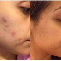 خلطة تبيض الوجه • علاج الكلف والنمش • علاج حب الشباب