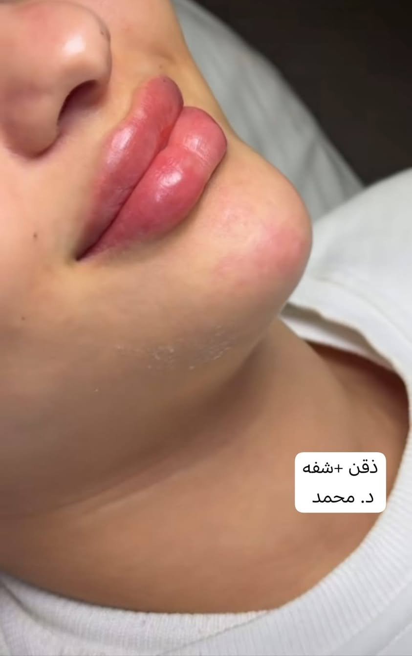 أحلا وأجمل العروض
1- قسم الاسنان 
حشوات تجميليه ب20 ألف أو 25 الف حسب تلافه ألسن 
تنضيف أسنان وبولش للاسنان ب 20 ألف 
تركيب الزاركون الألماني السن الواحد 75 ألف مع تنضيف أسنان واللثة مجاني بعد العمل

2-قسم التجميل والحقن للرجال والنساء 
فلر شفه أو وجنات 25 ألف 
تغيير شامل 250 الف
بلازما مفعله للوجه أو للشعر 15 الف
ميزو تساقط الشعر 35 الف
ميزو نضاره البشره 35 الف
ميزو تصبغات 35 الف
تنضيف عميق للبشره 15 الف

3-قسم الليزر 
ليزر الكانديلا الثلجي 
جلسه ازاله التاتو 10 الف
ليزر ازاله الشعر 15 الف
ليزر تحديد وجنات 15 الف 
ليزر رقبه كامل 20 الف
ليزر فل بدي جسم كامل 120 الف

مركز ايفا لتجميل الوجه والأسنان العنوان مدينة الصدر الكياره قطاع٦٧ مقابل نادي الجولان
‏‪***********‬‏📞

فحص ومعاينة مجاني يوميا مع اشعه للاسنان#
