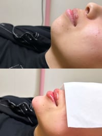 فلر شفه وذقن • رسمه طبيعيه • كربلاء الجمعية