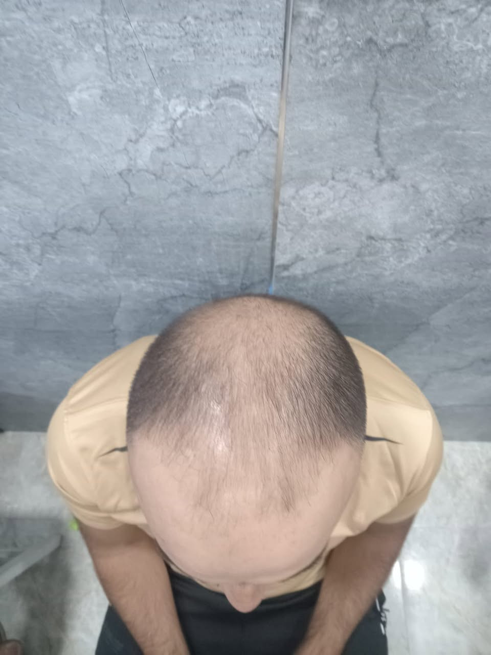 عيادة استيرا لزراعة الشعر والتجميل الانبار #الانبار  رمادي # شارع المستودع # مجمع كابيتال طابق 3 مجاور مطعم امً تي  ***********
