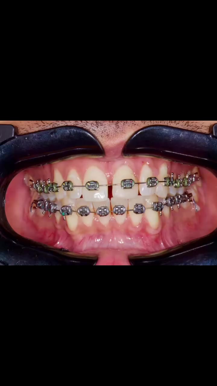 اذا الاسنان لونهم وشكلهم حلو،شنو الي يخلي الانسان بدل ما يعالجهم بالتقويم  ،يختار يبرد الاسنان ويسوي ابتسامة؟

الدكتورة جمانه محسن عبد
💜سيرتفكيت التجميل اللاجراحي (فلر وبوتوكس)
💜دبلوم مهني تقويم اسنان
💜عضو الجمعية الامريكية لتقويم الاسنان

🛑للحجز والاستفسار مراجعة الصفحة او الاتصال بالرقم
***********

🛑العنوان:عيادة الدكتور محمد حسن القريشي/واسط/الحي/شارع حي الوحدة قرب اسواق ريحانة

🛑علما ان المعاينة مجانية لتقويم الاسنان والتجميل اللاجراحي (فلر وبوتوكس)
