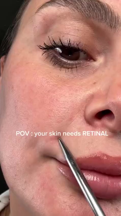 سيروم علاجي قوي يجمع بين مادتين من أشهر المكونات في عالم العناية بالبشرة: الريتينال (Retinal) و الماتريكسيل (Matrixyl).
سيروم ريتنول
فوائد الاستخدام:
شد البشرة: يساعد في تقليل مظهر المسام الواسعة والترهل.
محاربة التجاعيد: ينعم الخطوط الدقيقة حول العين والفم والجبهة.
توحيد اللون: يساعد في التخلص من التصبغات والبقع الناتجة عن الشمس أو حب الشباب.
نضارة فورية: يحسن ملمس الجلد ويجعله أكثر نعومة وإشراقاً.

طريقة الاستخدام الصحيحة (مهم جداً):
لأن المنتج يحتوي على ريتينال (مادة فعالة قوية)، يجب استخدامه بحذر:
الوقت: يستخدم في الليل فقط.
التدرج: ابدأ باستخدامه مرتين إلى 3 مرات في الأسبوع، ثم زد التكرار تدريجياً حتى تتعود عليه بشرتك.
الكمية: كمية بسيطة جداً (بحجم حبة البازلاء) للوجه كامل، وتجنب ملامسة العين مباشرة.
الترطيب: ضع مرطبك المعتاد بعده لضمان عدم جفاف البشرة.
الحماية: يجب استخدام واقي شمس في الصباح (ضروري جداً لأن الريتينال يزيد من حساسية الجلد للشمس).

سعر خاص
سيروم علاجي قوي يجمع بين مادتين من أشهر المكونات في عالم العناية بالبشرة: الريتينال (Retinal) و الماتريكسيل (Matrixyl).


**إذا كنت صاحب هذا الإعلان وتريد حذفه لأي سبب، رجاءا أرسل رسالة إلى الدعم الفني**