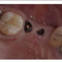 عيادات جامعة واسط • حشوات مجانيه • قلع اسنان مجاني