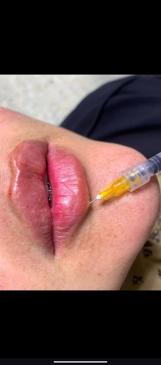 هلاو  بنات  عرض  العيد
فلر  شفه  الكوري ٣٠
 فلر  شفه  السويسري  ٤٠ 
فلر  شفه  الانكليزي  ٤٥ 
فلر  شفه  الايطالي  ٥٠
............. فلر الوجنات ........... 
فلر االخدود  الكوري  ٢٠  سي  الواحد 
فلر  الخدود  السويسري ٣٠ سي الواحد 
فلر  الخدود  الانكليزي  ٣٥  س الواحد 
فلر  خدود اليطالي ٤٠  س  واحد 
كل  اثنين  اخوات  او  صديقات  تاخذون  سيسي  مجاني  
..................... ابرةالنظاره ...... 
عرض  ابرة  الرتفال  ٢٥  
ابرة  العنبر  + ابلازمه  ٣٠ 
ابرة  طماطه  +  تنضيف  بشره  عميق  ٢٥ 
 ابرة  العروس  +  الفيتامين  سي  ٢٥ 
 ........................مكس  الايطالي  الخاص بدكتورا  ٥٠ الف  
تنضيف بشره  عميق هديه  
كل  اثنين  صديقات  او اخوات  الهم  هديه بختيارهم  من  داخل  صالون  
 ........ تغير شامل  الفلر  كوري  ١٠
يشمل  الخدود 
تكساس  
ذقن  
اصداع  
شفه  
150الف  
............. تغير شامل  الفلر  الاسويسري  ....... 
الخدود  
تكساس  
ابرزاز  ذقن  
اصداع  
شفه 
........... 200الف  +  اابرة الفيتامين سي هديه 
 ....... تغير شامل  الفلر  الايطالي  ....... 
الخدود 
تكساس  
ابراز  ذقن  
اصداع  
شفه 
250الف   +  ابرة العنبر  +بوتوكس  سحب  الحاجب


**إذا كنت صاحب هذا الإعلان وتريد حذفه لأي سبب، رجاءا أرسل رسالة إلى الدعم الفني**