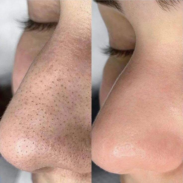 اهلا وسهلا جميلتنا عروض سبوت يرحب بيكم ودكتوره سحر اول سبوع من رمضان عروض نار فيلر شفه مع ابرة نضاره ٢٥ تغير شامل للوجه ١٠ سيسي فيلر مع ابرة نضاره وشد ١٥٠فيلر وجنات وخطوط ضاحكه ١٠٠ بوتوكس رفع حاجب وسحب عين ٥٠ ابلازمه للوجه مع فيلر شفه ٢٥ تنضيف بشره عميق ملكي ١٠ فيلر يد ١٠٠ سارعو بالحجز على الارقام ***********اهلا وسهلا جميلتنا
