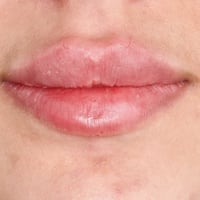 فلر شفة • تكنيك روسي • واسط