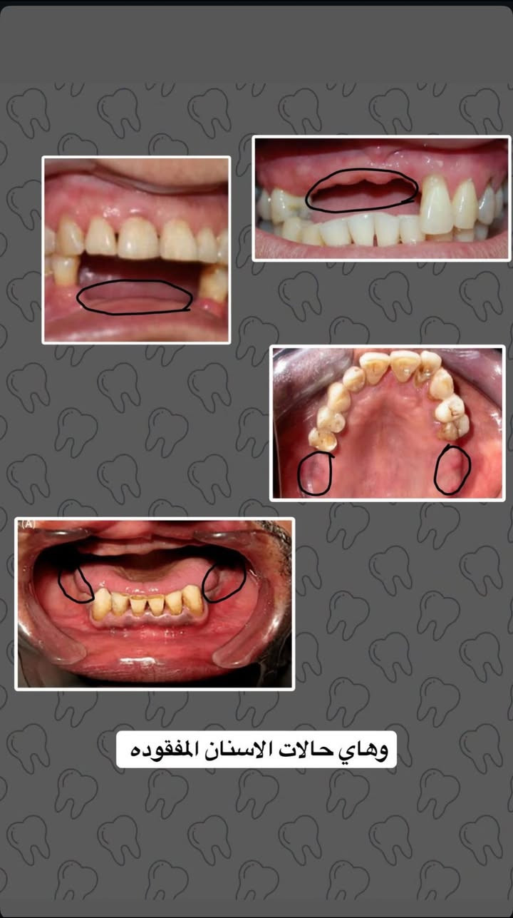 ✨تعويض الاسنان المفقودة ✨
المحتاج تعويض للاسنان المفقودة يتواصل ويايه على الخاص او على الواتس

***********

العلاج مجاني بالكامل وتحت اشراف اطباء اختصاص 

العنوان / جامعة الاسراء -كلية طب الاسنان
