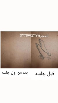 مركز قصمان • مسح التاتو والوشم • العمارة ميسان