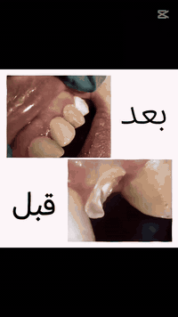 بناء سن امامي • تغليف سن • بعقوبة التحرير