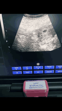 حمل جديد • سونار • عيادة نسائية