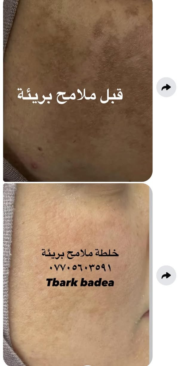 عليها القرأن الي مجربه براندي خلطة ملامح بريئة وفايدها تعلق اهنا بنات يتابعون التعليقات يردون يستخدموهاويستفسرون منكم  👈🌹


**إذا كنت صاحب هذا الإعلان وتريد حذفه لأي سبب، رجاءا أرسل رسالة إلى الدعم الفني**