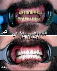 المختبر الفني السوري  لصناعة الاسنان و التعويضات السنية وتركيب الأسنان...