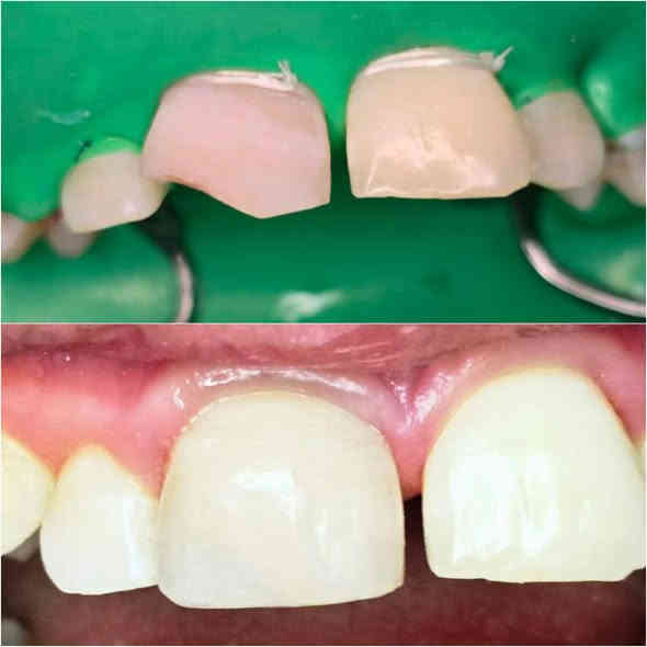 ⚡️ 30% خصم الآن!  عرض لا يُفوَّت! ⚡️

الدكتور وليد الفهداوي (بكالوريوس طب وجراحة الفم والأسنان
، سيرتفكت حشوات جذور ) يقدم :

​💰 العرض الأقوى (لفترة محدودة)!

​مجاناً: تنظيف وإزالة التكلسات والتصبغات عند حجز جلسة التبييض بالليزر!

​خصومات تصل إلى 30% على حشوات الضوئية و حشوات الجذور والقلع.

​فحص واستشارة مجانية لجميع الحجوزات.

​📞 احجز الآن!

للحجز ​اتصل على: ***********
العنوان: الرمادي _ الصوفية _ البومحل _ مجاور ملعب شهداء البومحل
