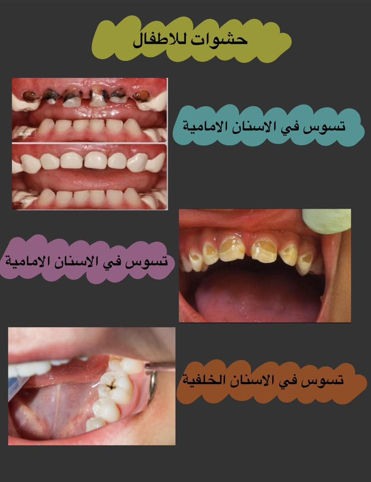 📍عيادات ابن سينا التخصصية-مقابل محطة وقود البياع
📝للحجز والاستفسار:
.مراسلة الصفحة
.واتساب ***********
✨علماً ان العلاج مجاني بالكامل
