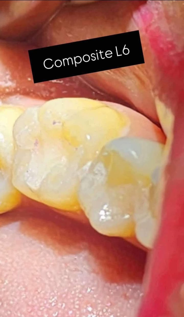 🔵🔵 عيادات النخبة 🔵🔵
د. نور صبيح صالح متمرّس في طب الأسنان وخبرة اكثر من سنتين في المجمعات الطبية (مجمع السلام الطبي و مجمع الواعظ الطبي) 

🔴حشوات الاسنان الضوئية

🔴تعويض الأسنان المفقودة

🔴قلع الأسنان التالفة والجذور

🔴تنظيف الأسنان من التكلسات والتصبغات

🔴معاينة وعلاج امراض والتهابات الفم (اللثة واللسان)

🔴تقويم للاطفال

🔴علاج اسنان الاطفال

 (تنظيف - حشوات - جلسات حماية من التسوس - قلع)

المعاينة والعلاج باحدث الاجهزة والمواد وخصيصآ قسم الحشوات براندات عالمية مثل ماركة GC و ماركة 3M
وموجودة دكتورة اسنان للعوائل المحافظة

العنوان : المنصور مقابل مستشفى الهلال الاحمر

التواصل والإستفسار :

***********
