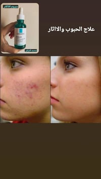 سيروم إيفاكلار • يعالج الحبوب • بشرة دهنية