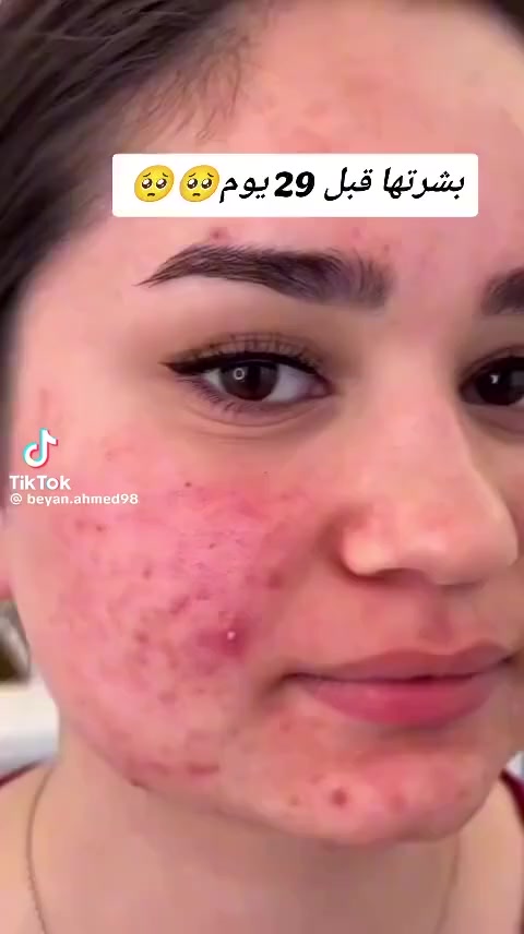 صابون جانوزي dxn

نحتاج الى الصابون كل يوم ولكن الكثير منا يستخدم صابون مليء بالكيماويات والتي تضر بالبشرة على المدى البعيد ، لذلك جاءتنا dxn بصابون يعتبر أفضل صابون ممكن تستخدمه! وهو صابونة جانوزي والتي هي صابونة طبيعية صحية! حيث أن مكوناتها طبيعية .

صابونة جانوزي ليست لمرض جلدي معين ولكنها صابونة صحية وآمنة يجب أن يستخدمها الصحيح قبل المريض فهي تحافظ على الجلد وتنظفه ، كما تعمل على تفتيح البشرة مع الاستمرار عليها .

بعد فوائد صابون جانوزي dxn

1-تعمل على منع تضرر خلايا الجسم.

2-تساعد على تنشيط البشرة ومنع الأكسدة، وذلك بسبب وجود خلاصة الـ(جانوديرك) الموجود بفطر الجانوديرما 
.
3-تجعل البشرة جذابة بسبب وجود زيت النخيل المقوى بالفيتامين (هـ) والعوامل المضادة للأكسدة.

4-تتميز بقوة في إزالة الأوساخ.

5-تساعد على ازالة البثور من الوجه.

6-تنظف البشرة ولا تزيل الزيوت الطبيعية الموجودة بها .

7-تساعد على الوقاية من الإصابة بمشاكل البشرة .

8-تساعد على تفتيح المناطق الداكنة في الجسم مع الاستمرار عليها، مثل والكوع والركبه وتحت الابط وغيرها من المناطق.

ولها الكثير من الفوائد الأخرى ، ويكفي أنها مكونة من مكونات طبيعية .👌🏻

كيفية استخدام صابون جانوزيdxn
1- قم بتدليك وجهك بماء دافئ. 

2-اغسلها بالصابون ودلك الوجه بالرغوة قليلا.

 3-ثم اترك الصابون على بشرتك لمدة  حوالي دقيقتين الى عشر دقائق.

4- ثم قم بغسله بالماء البارد جيدا.
الواتساب للإستفسار أكثر


**إذا كنت صاحب هذا الإعلان وتريد حذفه لأي سبب، رجاءا أرسل رسالة إلى الدعم الفني**