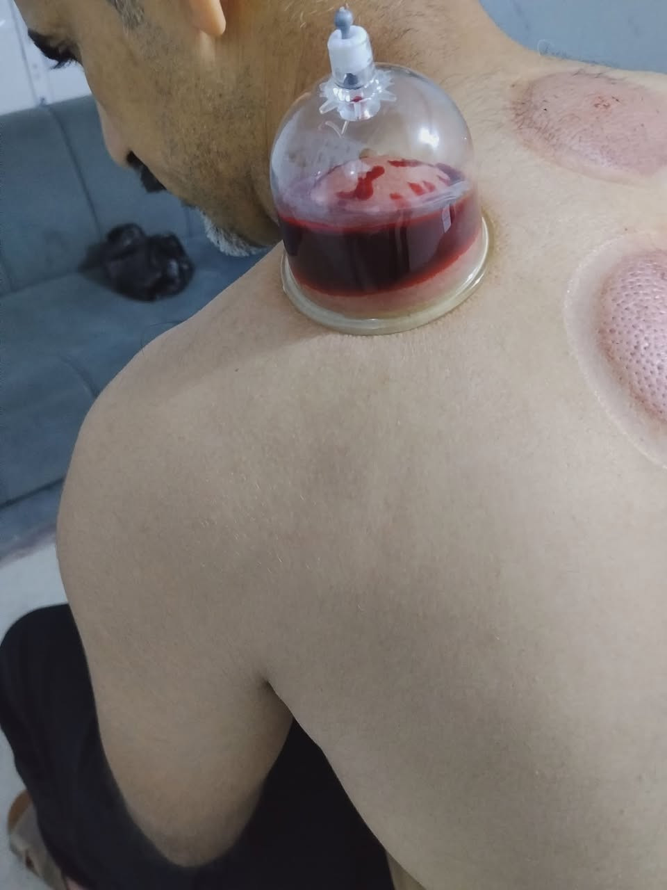 حجامة الشفاء 
حجامة كاملة متكونة من خمسة گلاصات 
السعر 10 الاف دينار 
عنوان المركز 
مركز الشفاء عيادة جبراوة 
***********
