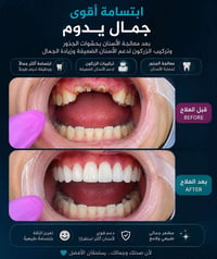 تيجان زركون • دعامات فايبر • معالجة الجذور