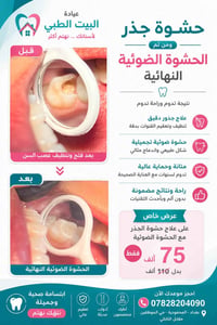 حشوة جذر • حشوة ضوئية • المحمودية