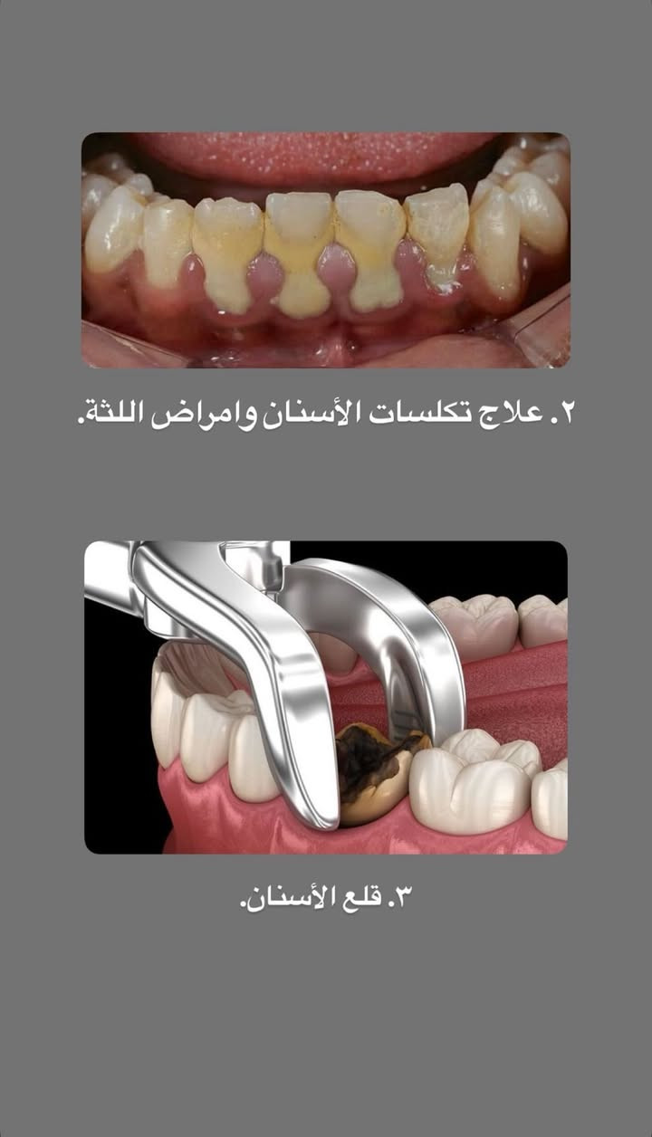 السلام عليكم ورحمة اللّٰه وبركاته 🦷🪥
الى كل من يحتاج رعاية طبية لأسنانه وذلك من

🔴حشوات تجميلية بيضاء
🔴حشوات جذور
🔴قلع الاسنان التالفة او الجذور المتبقية
🔴تنطيف التكلسات القوية
🔴قلع أسنان الاطفال
🔴تقويم أسنان للاطفال
جميع هذه الخدمات متوفرة في العيادات التعليمية لجامعة ذي قار علماً بأن العلاج مجاني ماعدا تكلفة الباص .
وهذه بعض من الحالات التي تم علاجها على يد 
الدكتورة: غدير جاسم محمد / المرحلة الخامسة
العنوان: حي اور / كلية طب الاسنان مقابل مستشفى الحسين التعليمي فرع الطب العدلي
للحجز: التواصل على الخاص او الرقم *********** او على حساب الانستكرام
gh_clinic0

