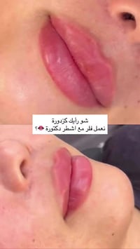 فلر شفة • تجميل • شفة
