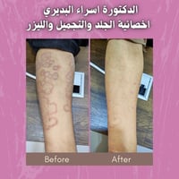 نتيجة التشخيص الصح والعلاج الصح والالتزام هيج تكون بعد معاناة سنة كامل...