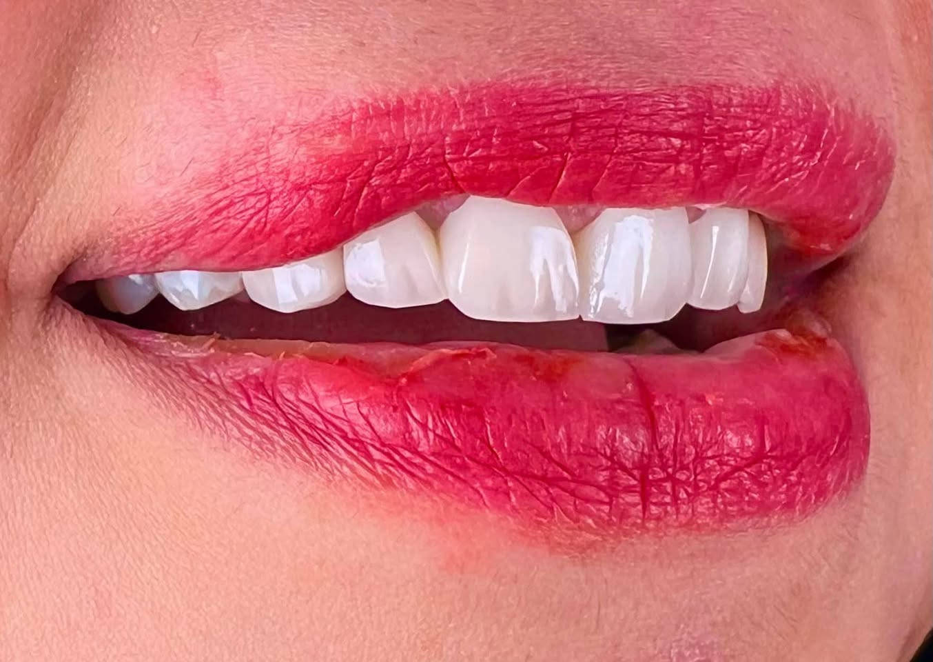 استبدال تركيب من السيراميك للضرورة المعالجة فتم اعادة الأبتسامة الجميلة لمراجعتنا بعد معالجة الآسنان وتغليفها بتركيبات الزيركون 
العنوآن ميسان الماجدية شارع الملعب خلف مركز الشرطة امام جامع الثقلين 
عيادة البتول 
للحجز والاستفسار 
*********** عمارة, ميسان

