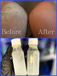 كالوس القدم • ازالة الجلد الميت • اصلي اماراتي