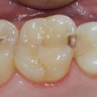 مرحبا منو عنده هيج تسوسات ومحتاج يحشيهن يتواصل ويايه خاص او واتس 07730...