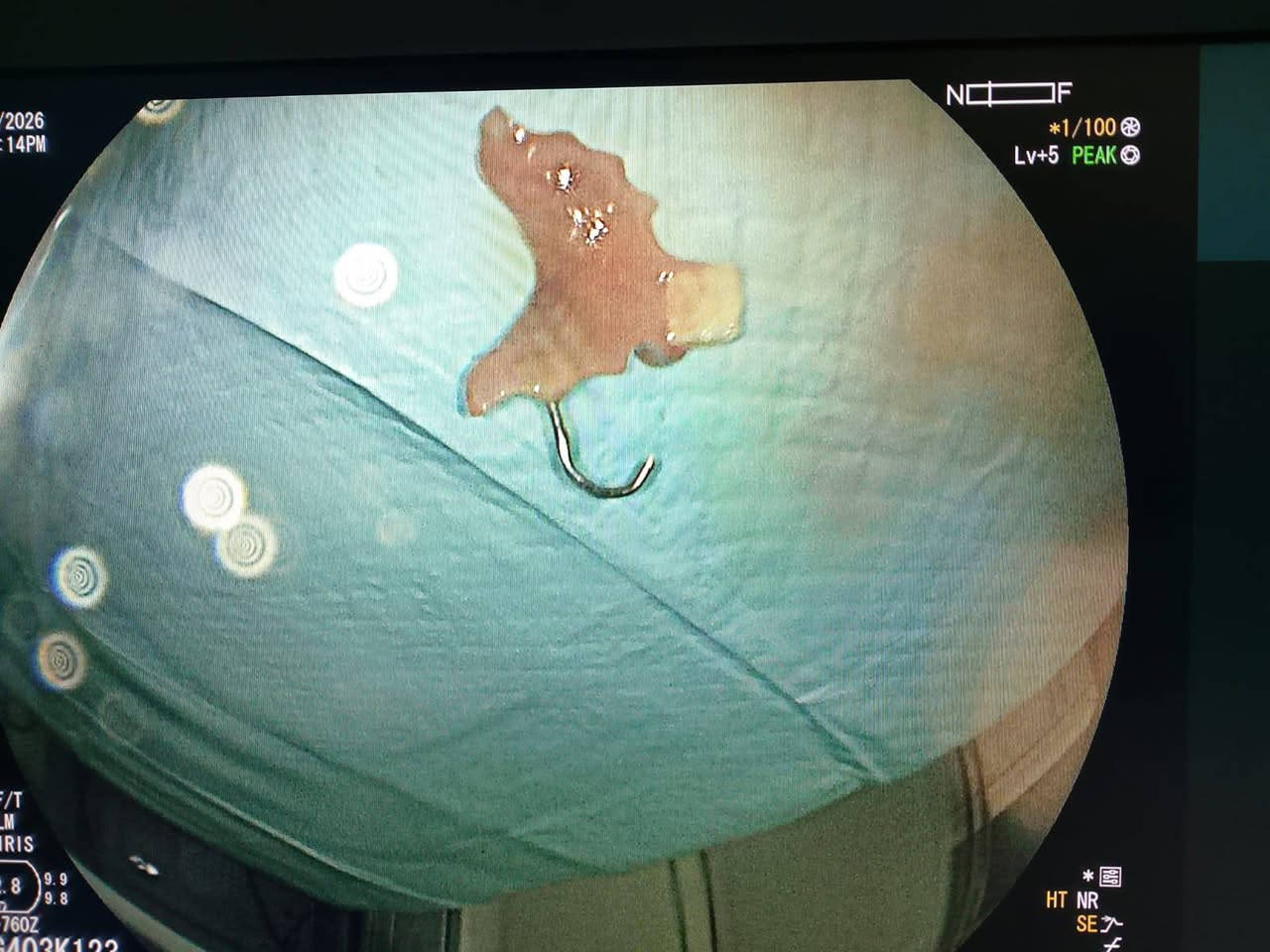 #يوم 15/3/2/26 #اثناء صباح رمضان المبارك استقبلنا #رجل ستيني  #ابتلع #سن اسنان #صناعي كبير جدا مع عموده #الحديدي #المعقوف  متوقف في وسط البلعوم  وبين اكمال الاجراءات وارسال الاشعة تم تأكيد المكان وتحضير كادر المناظير المتقدم الاخ ابو ليان مرتضى و الأخ امجد ابو مقتدى 
وبمتابعة #مقيمنا البطل الطبيب الاقدم
#أجرينا #باشرافنا له #ناظور تداخلي واستخرجنا السن مباشرة ولكن #بصعوبة بالغة جدا لان #السن كان كبير وفيه الحديد #المعقوف على هيئة #الشص لصيد السمك.كما موضح بالصورة 
#نرفق مع المنشور إحدى #هدايا الإخوان من قضاء #الرفاعي درع #التمييز من قبل اخينا الفاضل #ايمن #ثجحيل وذوقه الرفيع في تكريمنا .
 #الطبيب #الاستشاري #د.يعقوب يوسف الكوفي 
 #فوق التخصص دقيق 
#أمراض ومناظير الجهاز الهضمي والكبد 
***********
