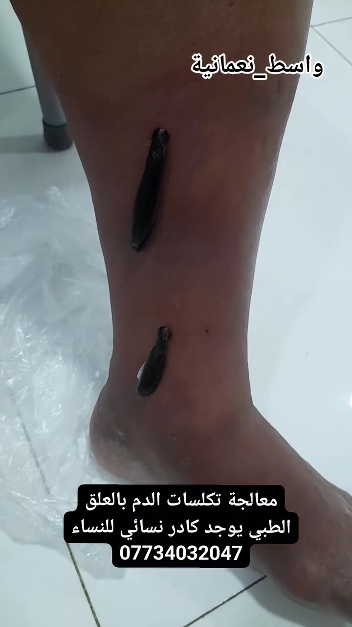 #معالجة #تكلسات الدم #بالعلق الطبي
يُستخدم العلق الطبي في بعض ممارسات الطب التكميلي لتحسين الدورة الدموية في مناطق محددة والمساعدة على تخفيف #الاحتقان الوريدي في بعض الحالات. ويحتوي لعاب العلق على مواد #طبيعية قد تساعد في منع تخثر الدم
 #العنوان محافظة #واسط قضاء #النعمانية #شارع 13 مقابل صيدلية علاء حسين كريم 
للاستفسار ***********
 

#الحجامة_النسائية
#الحجامة
#الطب_البديل
#العلاج_بالحجامة
#الصحة
#العافية
#الاستشفاء
#العلاج_الطبيعي
#العناية_بالمرأة
#صحة_المرأة
#الحجامة_للنساء
#النعمانية
#واسط
#العراق
#المصطفى_للحجامة
#طب_بديل
#الوقاية
#الصحة_والعافية
#حجامة_علاجية
#حجامة_وقائية
 #الجميع 
 #اشارة 
 #متابعين 
 #الكل
#everyone  
#followers
