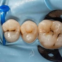 كربلاء الحر الصغير • علاج اسنان مجاني • حشوات ضوئية