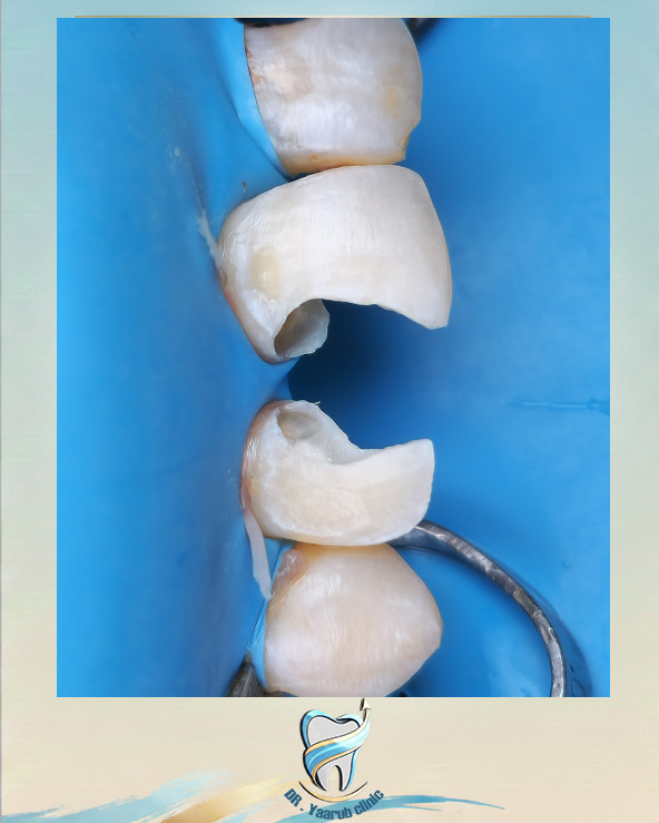 🔹 حالة علاجية – القواطع الأمامية 🔹
المراجع كان يعاني من مشاكل في الأسنان الأمامية شملت: ألم، تضرر في القواطع ، وتغير في اللون.
تم إجراء:
🦷 علاج جذور كامل
🦷 حشوات تجميلية متقدمة
لإعادة بناء الأسنان بشكل صحي وجمالي.
الهدف:
✔️ إيقاف الألم
✔️ تقوية السن
✔️ استعادة اللون الطبيعي
✔️ تحسين الابتسامة بشكل متناسق
النتيجة: ابتسامة طبيعية ✨
أسنان أقوى
وشكل جمالي يليق بالمراجع
في عيادة الدكتور يعرب عدنان الجوراني نستخدم أحدث التقنيات والمواد العالمية لضمان أفضل نتيجة علاجية وتجميلية.
📍 الموقع : مجمع النورين التجاري , ركن شارع الشيشان_مقابل منطقة الحاوي
📞 للحجز: ***********
طب وتجميل الأسنان بأحدث التقنيات العالمية 🦷💎
