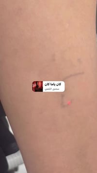 ازالة التاتو في عيادة فور يو لليزر بجهاز الفاي ليزر الاحدث عالمياً بدو...