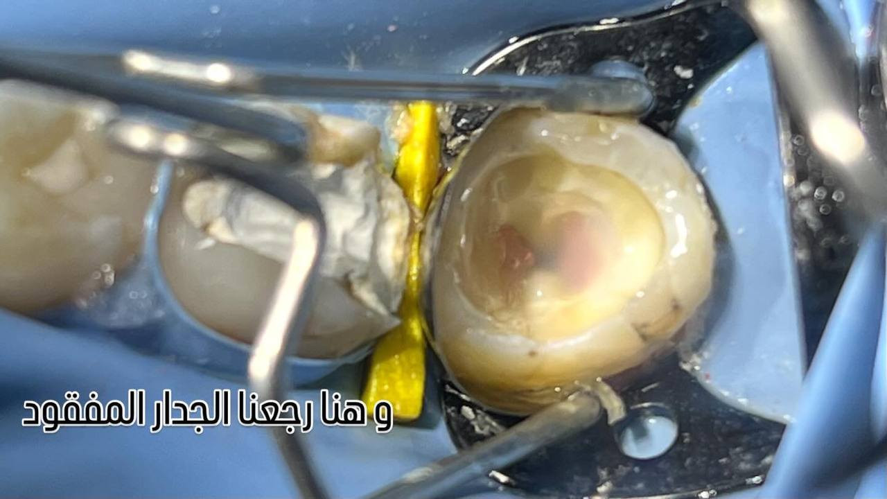 خطوات حشوت الجذر داخل العيادة  
صحة اسنانك ويا عيادة بيانو غير 🥰
 
المكان/ حي 17 الشارع العام لمكتبة المهندس مجاور لمدرسة المشاعل

 للحجز والاستفسار/ ***********
