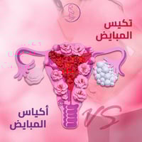 تكيس المبايض • أكياس المبايض • د. زهراء الياسري