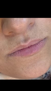 فيلر الشفه • دكتورة فرح • بعقوبة